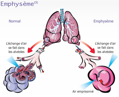 L'emphysème pulmonaire
